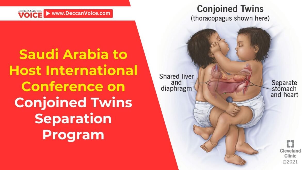 Saudi Arabia to Host International Conference on Conjoined Twins Separation Program - deccanvoice.com