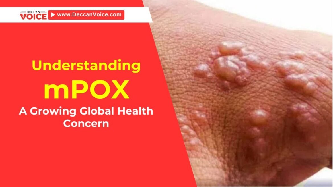 What is mPOX: A Growing Global Health Concern - deccanvoice.com